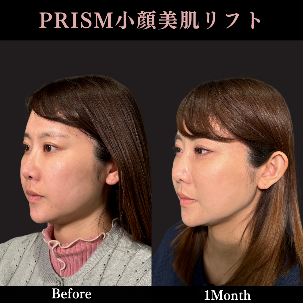 PRISMリフト