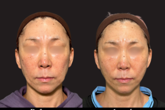 アルテミスリフト