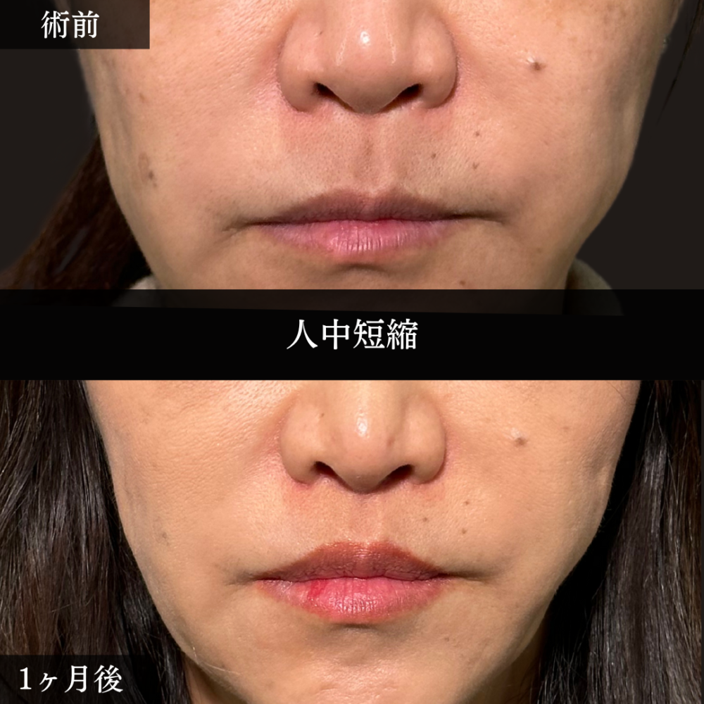 人中短縮