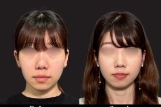 PRISMリフト＋ヒアルロン酸注射（頬）