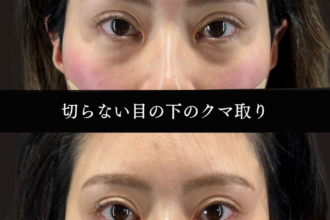 切らない目の下のクマ取り