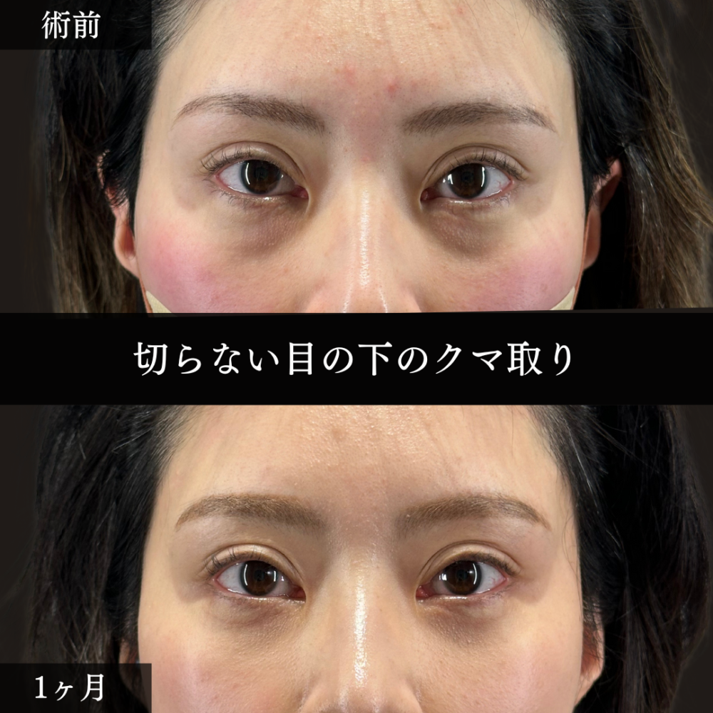 切らない目の下のクマ取り