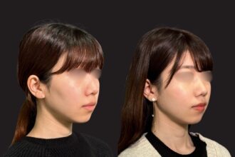 PRISMリフト＋ヒアルロン酸注射（頬）