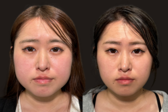 ボトックス注射（エラ）