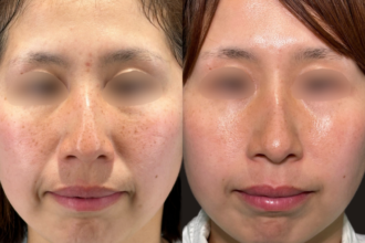 美人レーザー(MIINレーザー) トーニング＋スポット シミ取り放題