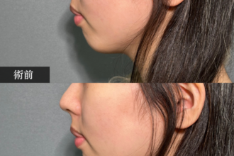 ヒアルロン酸注射（あご）