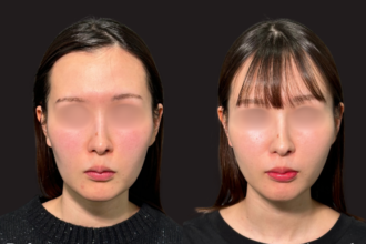 グランリフト+ヒアルロン酸注射(頬) グランリフト+ヒアルロン酸注射(頬)