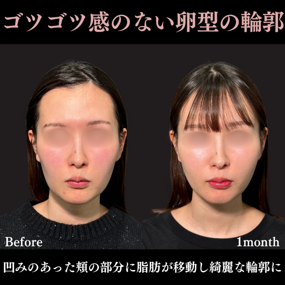 神保茉奈 Xclinic Osaka 似合わせヒアルロン酸/糸リフト