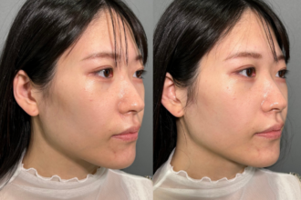 ヒアルロン酸(頬) ヒアルロン酸(頬)