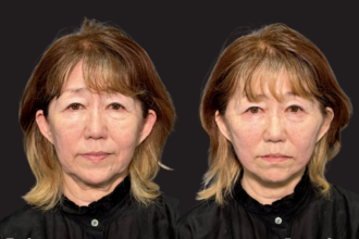 ジョールファット除去＋ウルトラソフト