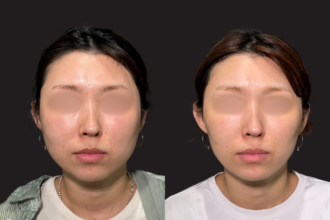 脂肪吸引クイック（頬・顎下）