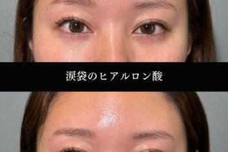 ヒアルロン酸(涙袋) ヒアルロン酸(涙袋)