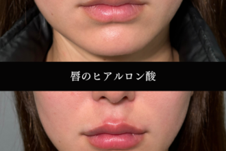 ヒアルロン酸(唇) ヒアルロン酸(唇)