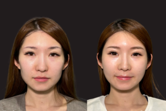 アルテミスリフト+ヒアルロン酸注射(頬・額・貴族) アルテミスリフト+ヒアルロン酸注射(頬・額・貴族)