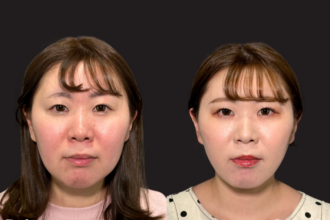 脂肪吸引クイック（頬・顎下）