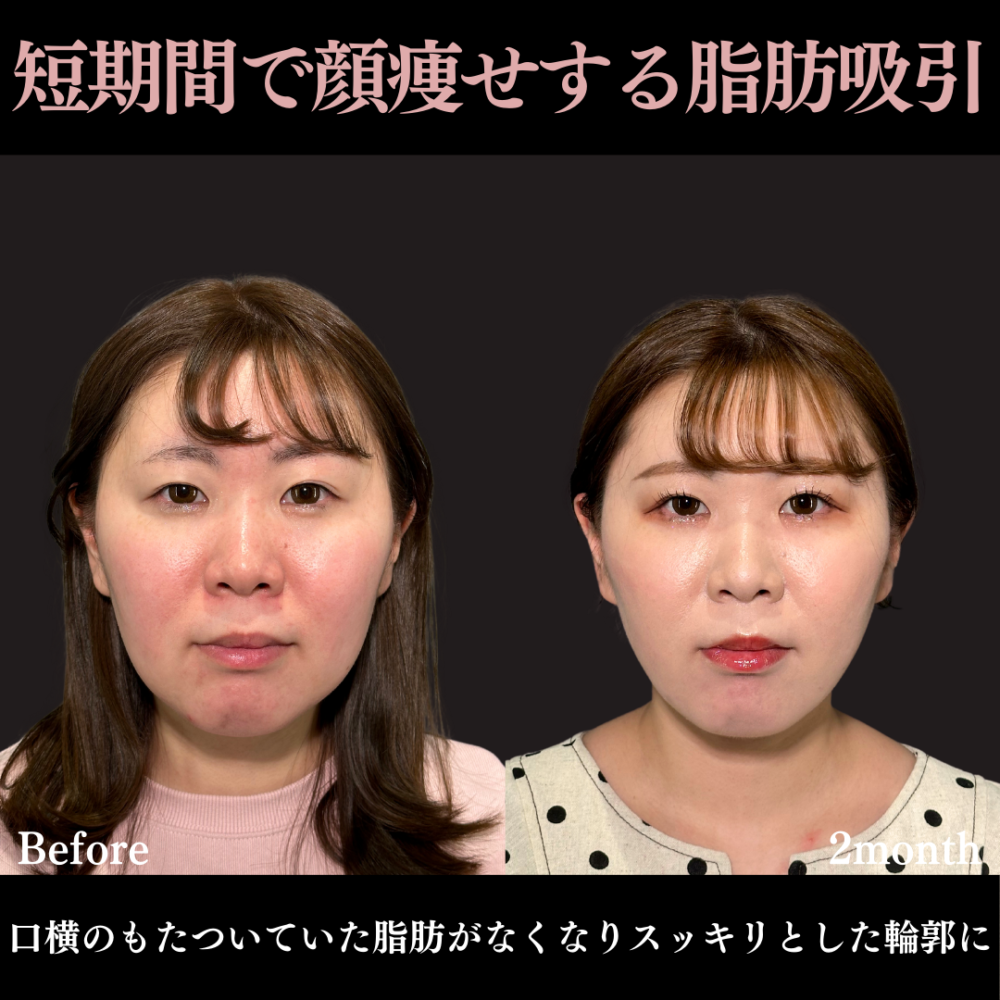 脂肪吸引クイック（頬・顎下）