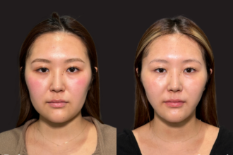 脂肪吸引プレミアム（頬・顎下）＋ グランリフト ＋ ウルトラソフト