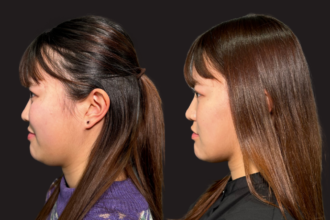 顔の脂肪吸引（頬・顎下）＋メーラーファット除去＋ウルトラソフト