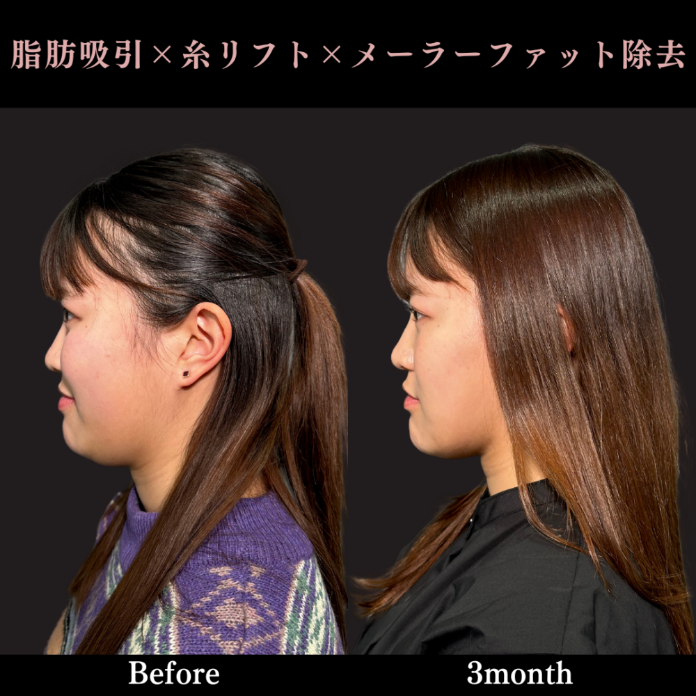 顔の脂肪吸引(頬・顎下)+メーラーファット除去+ウルトラソフト 顔の脂肪吸引(頬・顎下)+メーラーファット除去+ウルトラソフト