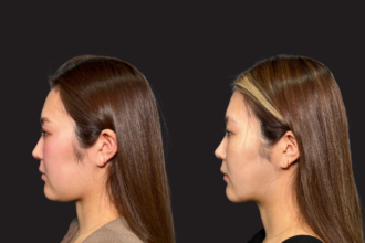 脂肪吸引プレミアム（頬・顎下）＋グランリフト ＋ ウルトラソフト