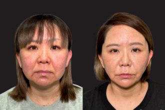 脂肪吸引プレミアム（頬・顎下）＋グランリフト＋ウルトラソフト