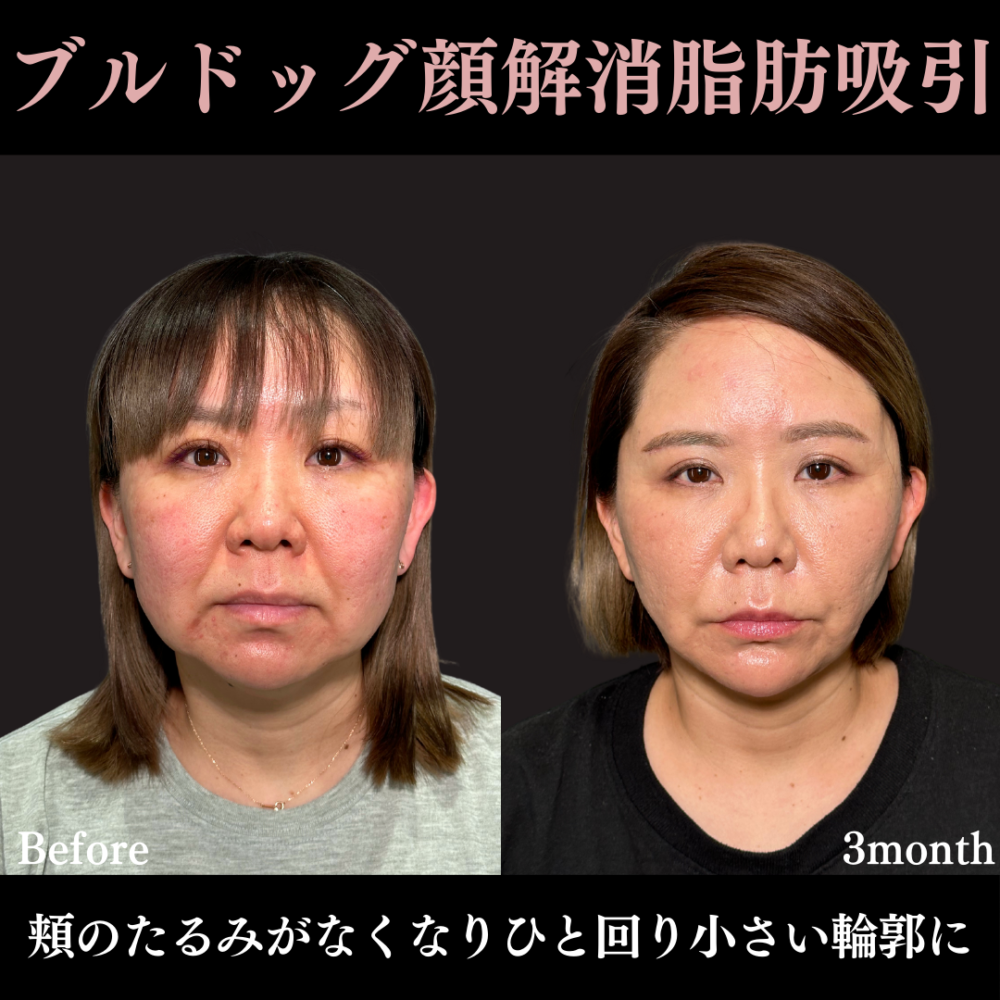 脂肪吸引プレミアム（頬・顎下）＋グランリフト＋ウルトラソフト