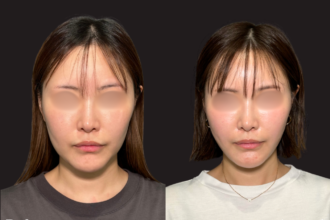 脂肪吸引プレミアム（頬・顎下）＋糸リフト