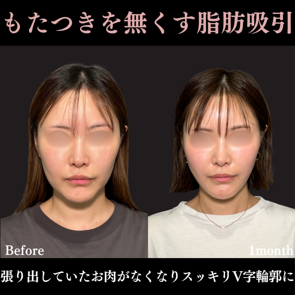 脂肪吸引プレミアム（頬・顎下）＋糸リフト