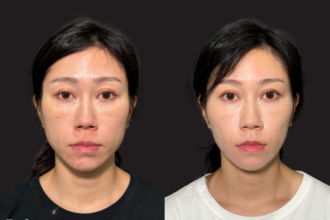 アルテミスリフト＋ エラボトックス