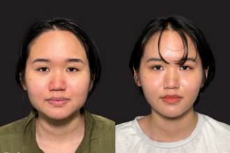 脂肪吸引プレミアム（頬） ＋ エラボトックス