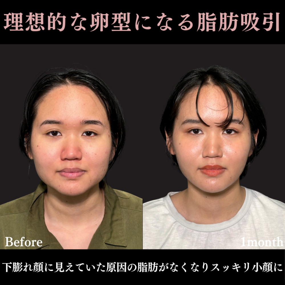 脂肪吸引プレミアム（頬） ＋ エラボトックス - 東京 町田の美容