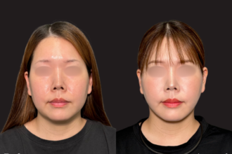 脂肪吸引（頬・顎下）＋ グランリフト