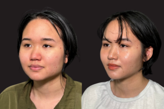 脂肪吸引プレミアム（頬） ＋ エラボトックス