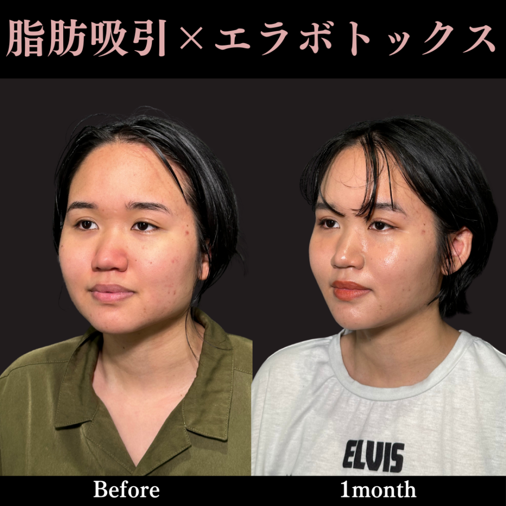 脂肪吸引プレミアム（頬） ＋ エラボトックス