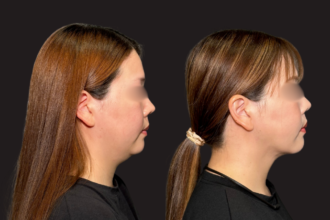 脂肪吸引（頬・顎下）＋ グランリフト