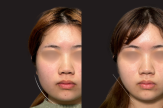 脂肪吸引クイック（頬）＋エラボトックス