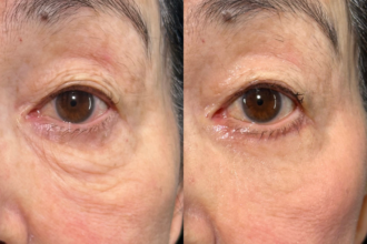 目の下のたるみ取り（下眼瞼除皺術）