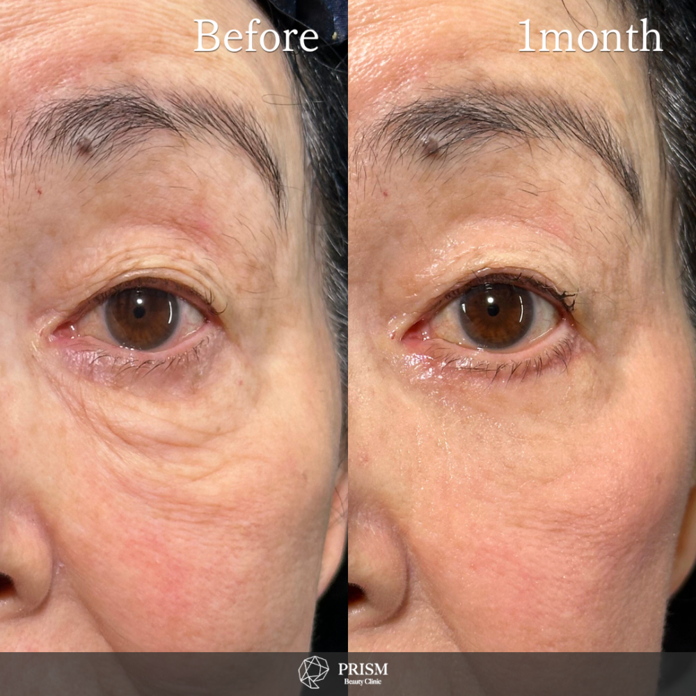 目の下のたるみ取り（下眼瞼除皺術）