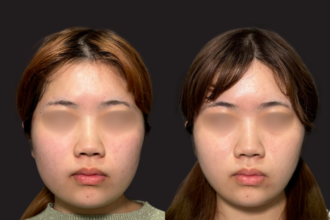 脂肪吸引クイック（頬）＋エラボトックス