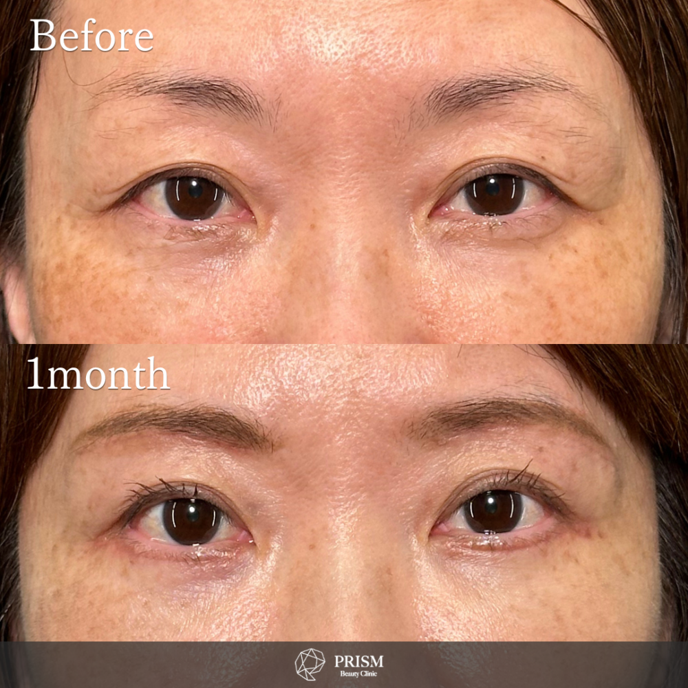 眉下リフト 眉下リフト