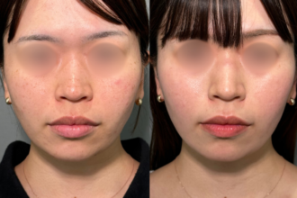 美人レーザー(MIINレーザー) 【トーニング】【コラーゲントーニング】【スポット シミ取り放題】 美人レーザー(MIINレーザー) 【トーニング】【コラーゲントーニング】【スポット シミ取り放題】