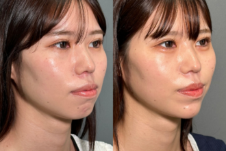 ヒアルロン酸(顎、涙袋) ヒアルロン酸(顎、涙袋)