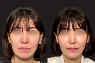 グランリフト+ウルトラソフト+ヒアルロン酸注射(頬) グランリフト+ウルトラソフト+ヒアルロン酸注射(頬)