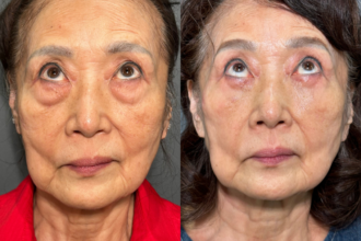 切らない目の下のクマ取り+ヒアルロン酸(目の下) 切らない目の下のクマ取り+ヒアルロン酸(目の下)