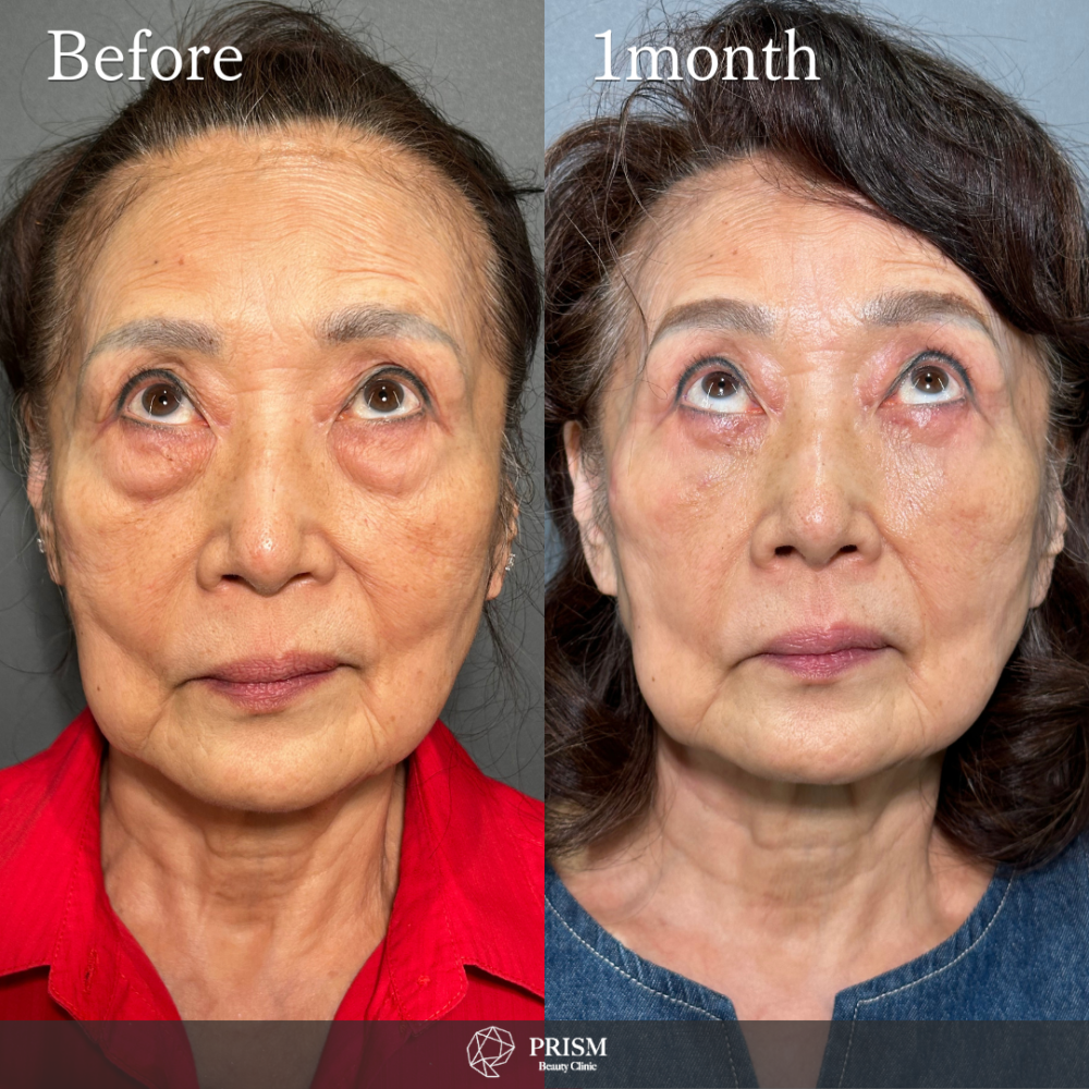 切らない目の下のクマ取り＋ヒアルロン酸（目の下）