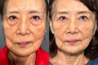 切らない目の下のクマ取り+ヒアルロン酸(目の下) 切らない目の下のクマ取り+ヒアルロン酸(目の下)