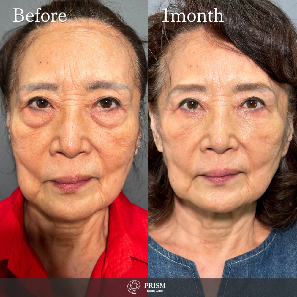 切らない目の下のクマ取り＋ヒアルロン酸（目の下）