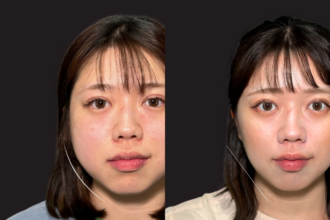 バッカルファット除去＋エラボトックス