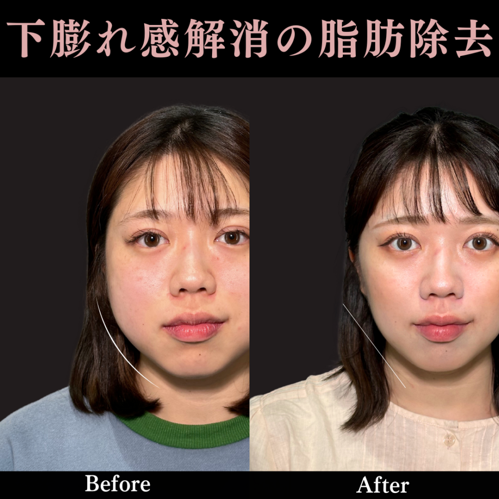 バッカルファット除去＋エラボトックス