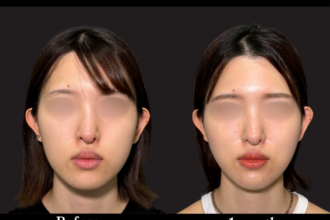 ジョールファット除去 ＋ 糸リフト